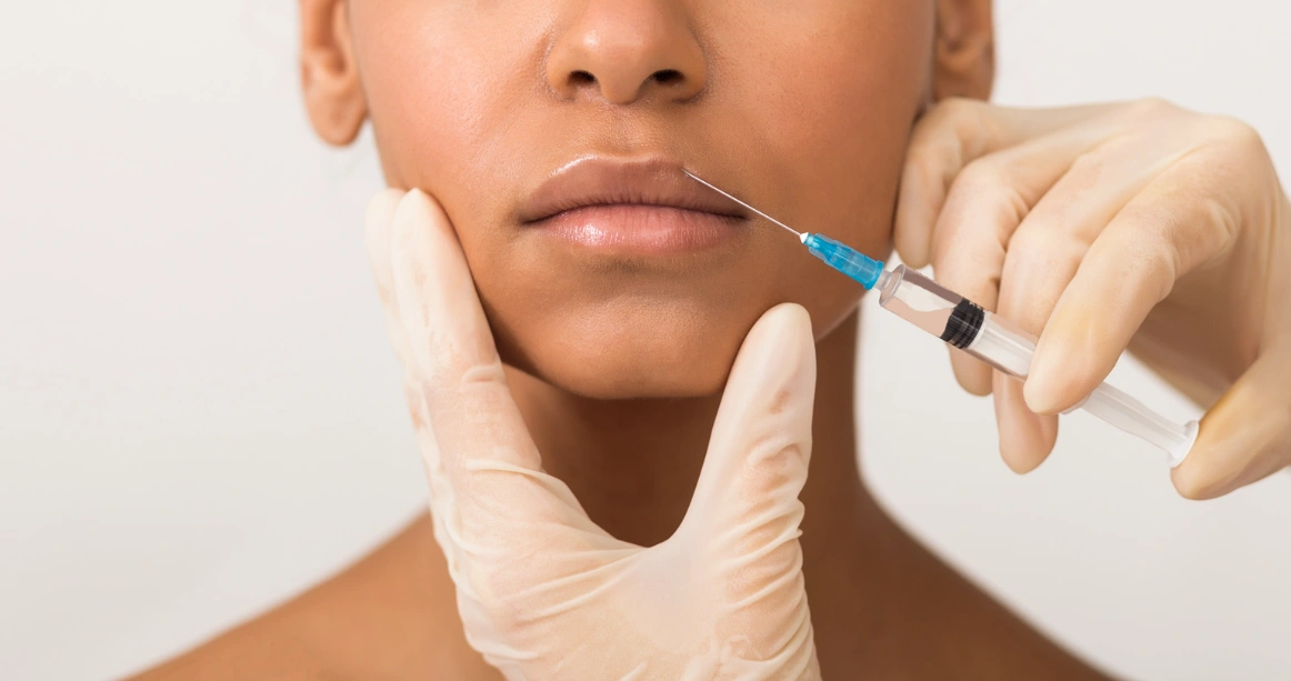 Lip Filler cannule