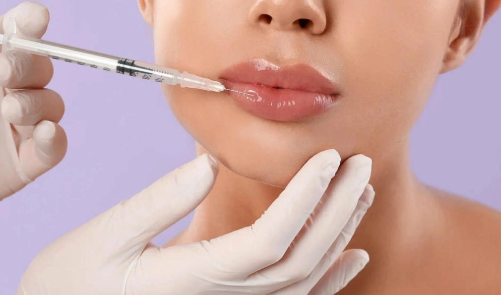 Swedish Lip Filler